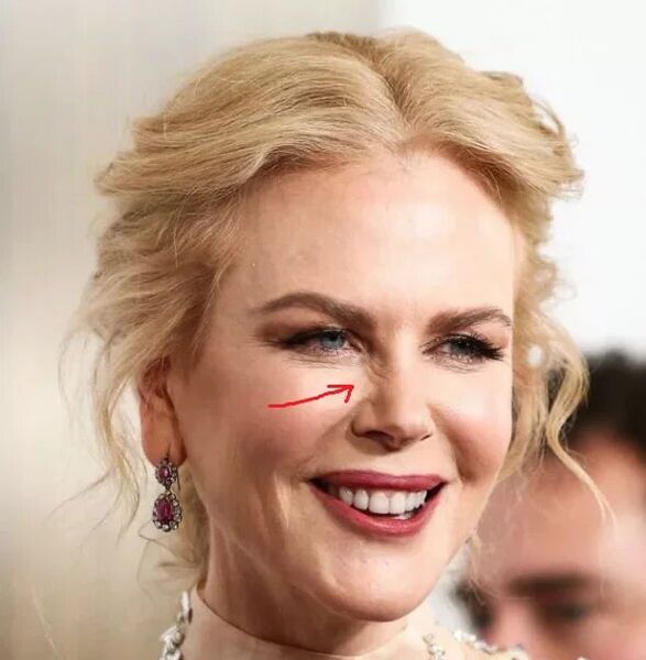 Alternatif pikeun Botox